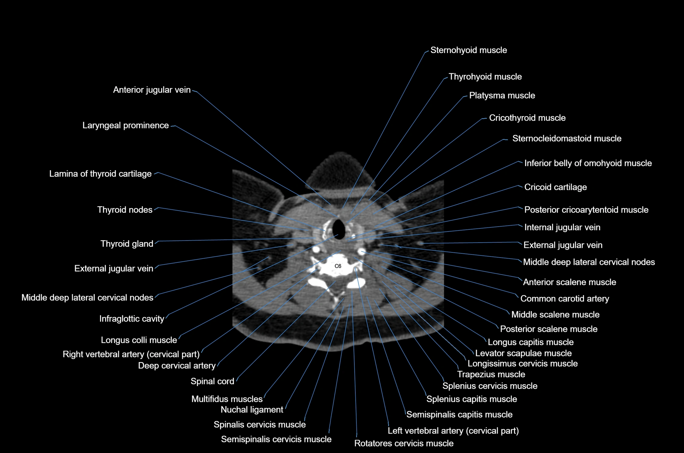 CT Neck axial cross sectional anatomy radiology image-img-00001-00045.webp